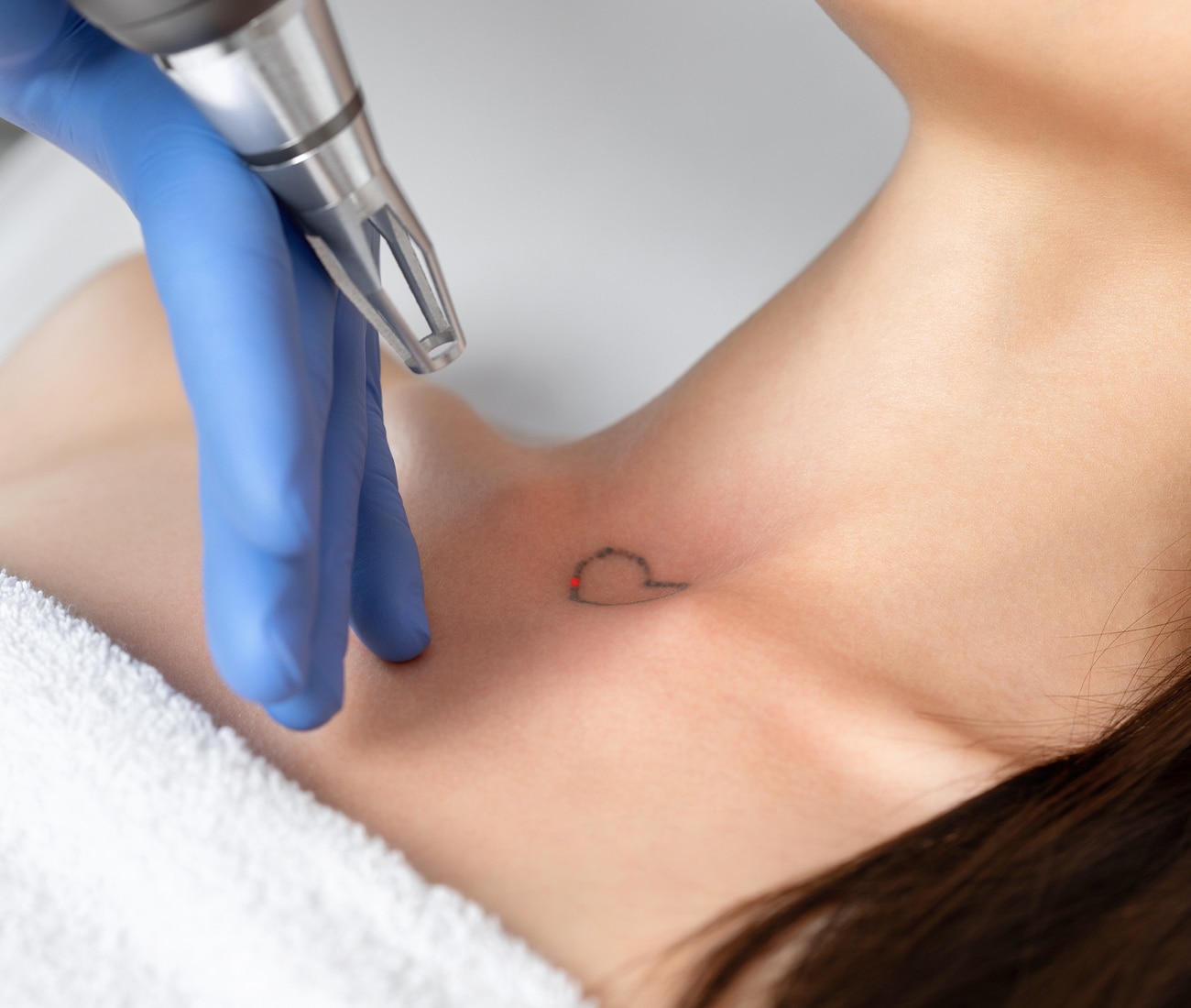 Laser Tattoo Removal | Safe & Effective Tattoo Removal | Pure Medical Spa